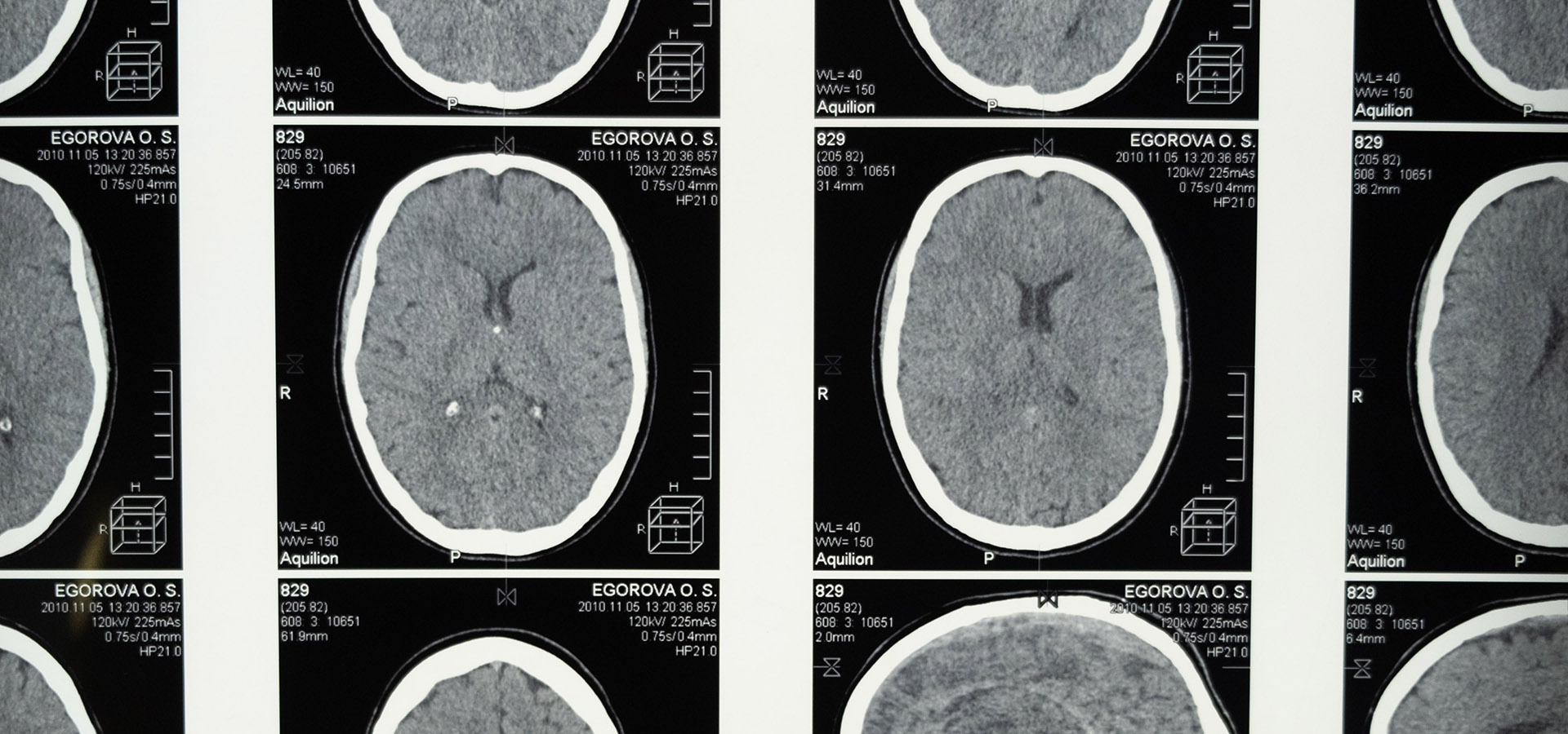 METASTASI CEREBRALI MELANOMA